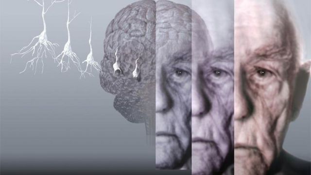 Болезнь Альцгеймера: причины, симптомы и лечение.