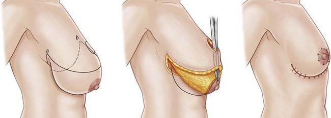 Операция по уменьшению груди и показания для операции