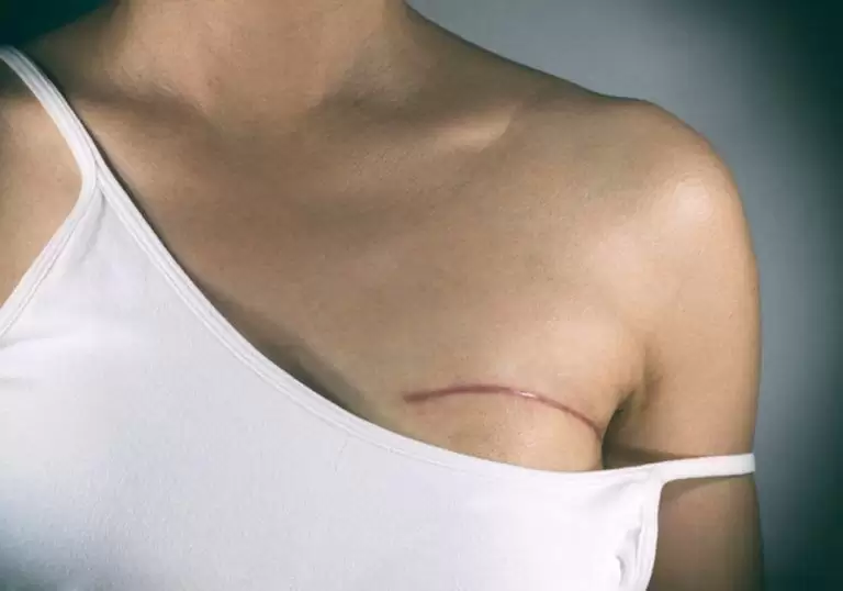 Пластическая реконструкция груди после мастэктомии: восстановление женственности