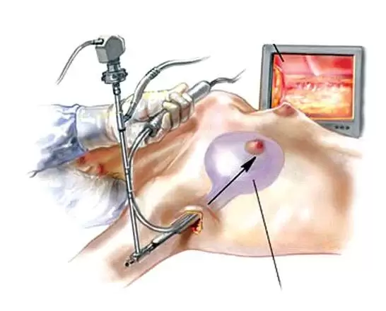 Новейшие технологии в маммопластике: Революция в косметической хирургии