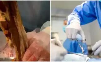 Алматинка 9 месяцев жила с забытой в животе салфеткой