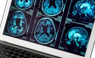 Препарат от Альцгеймера: забытое возвращается в память