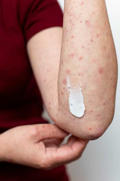 Дерматит аллергический