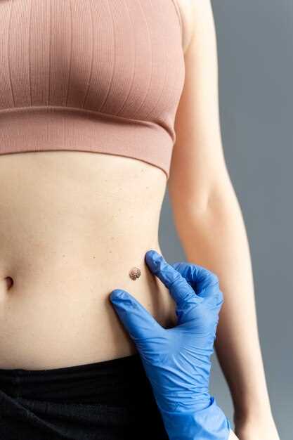 Паховая эпидермофития