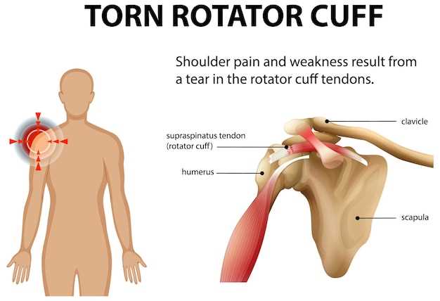Перелом большого бугорка плечевой кости