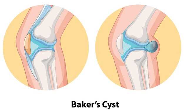 Повреждение менисков коленного сустава