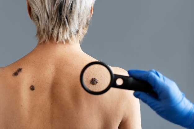 Рак Педжета