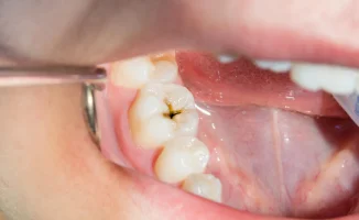 Учёные Калифорнийского университета нашли простой способ защиты зубов от кариеса