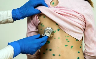 В Алматы растет заболеваемость ветрянкой среди детей