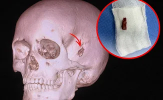 10-летний казахстанец 5 лет жил с куском дерева в голове: уникальный случай в Павлодаре