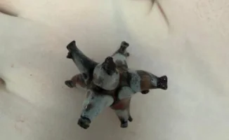 Шымкентские хирурги извлекли из почки пациента 'камень' с характером