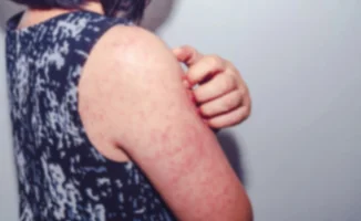 Снова вспышка кори в Казахстане: сотни заболевших детей без прививок