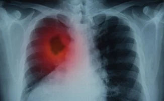 НДКТ-скрининг: ключ к раннему выявлению рака легкого