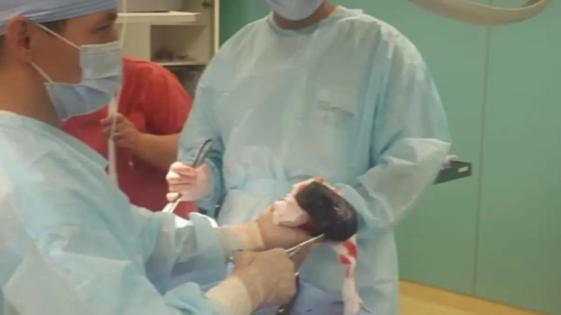 В Алматы хирурги удалили трихобезоар из желудка 25-летней пациентки после 5 лет страданий