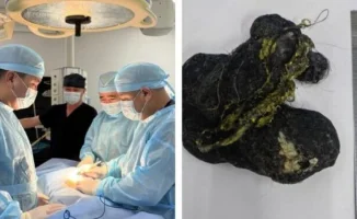 Шымкент: из желудка 8-летнего ребенка извлекли ком волос