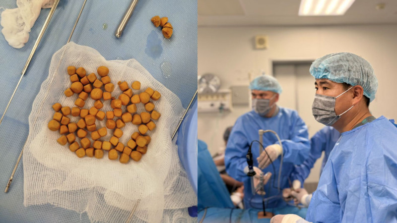 В Туркестане врачи удалили 80 камней из мочевого пузыря 61-летнего пациента