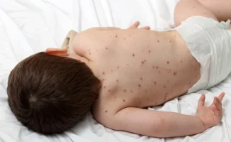 Мировая угроза: Казахстан сталкивается с третьей вспышкой кори с 2019 года