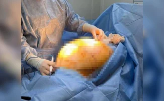 68-летней женщине в Алматы удалили опухоль весом 25 кг после лечения БАДами