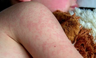 Ситуация с корью в Казахстане: Алматы и другие регионы фиксируют новые случаи заболевания