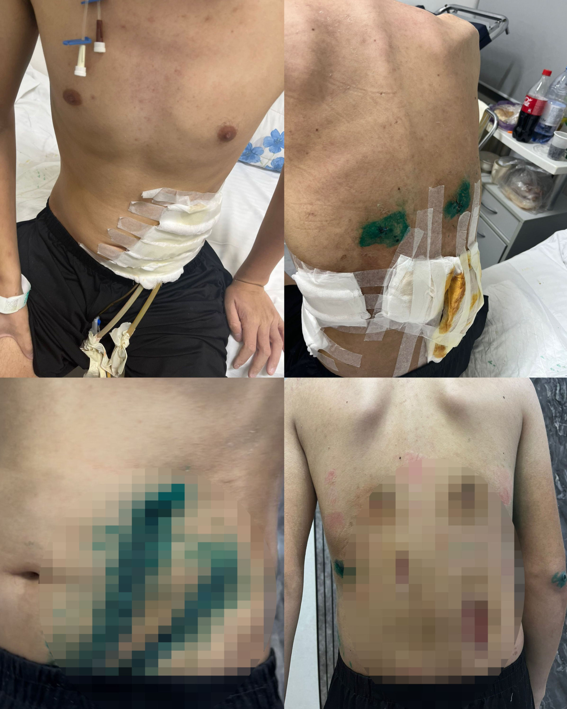 Фирдауси после одной из операций.